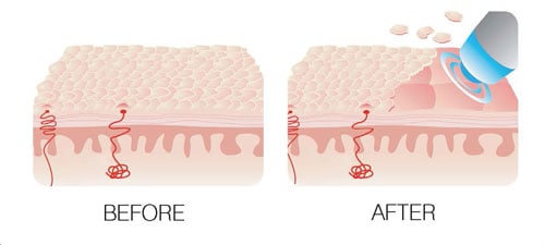 orbital-microdermabrasion-after-before